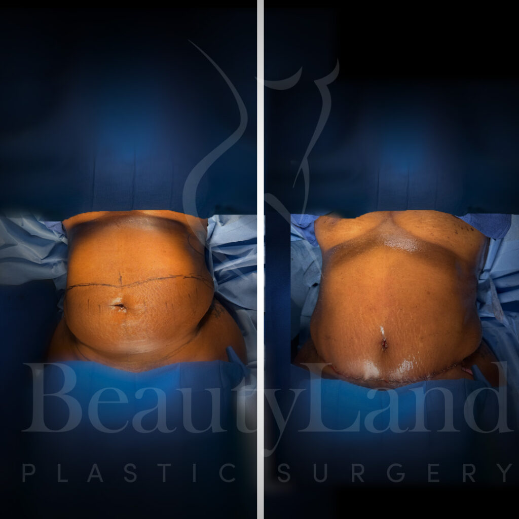 Tummy Tuck