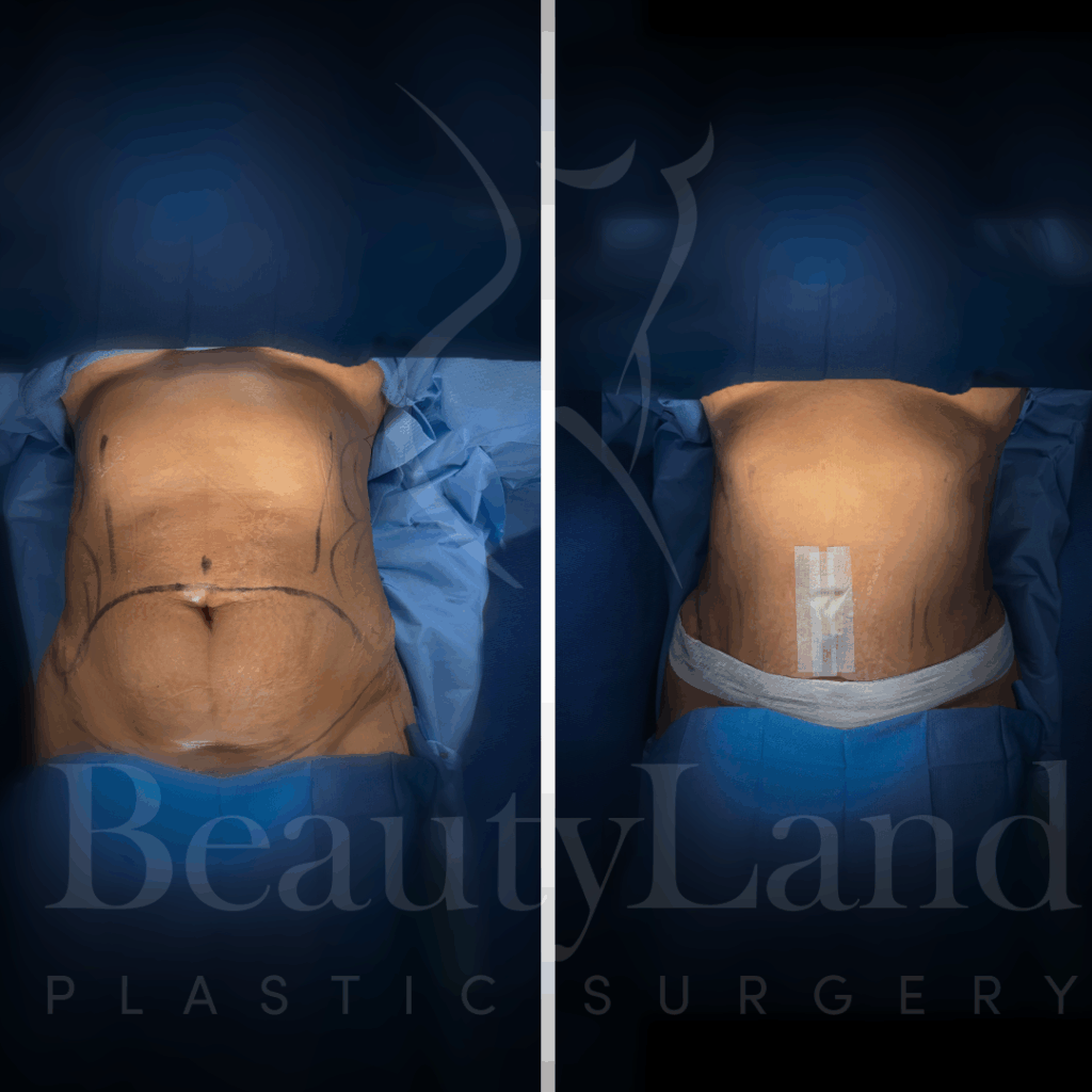 Tummy Tuck