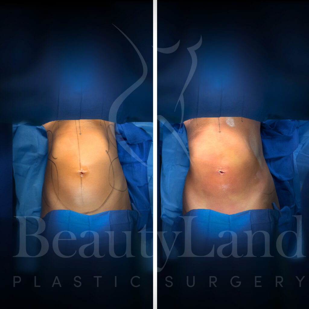 Liposuction