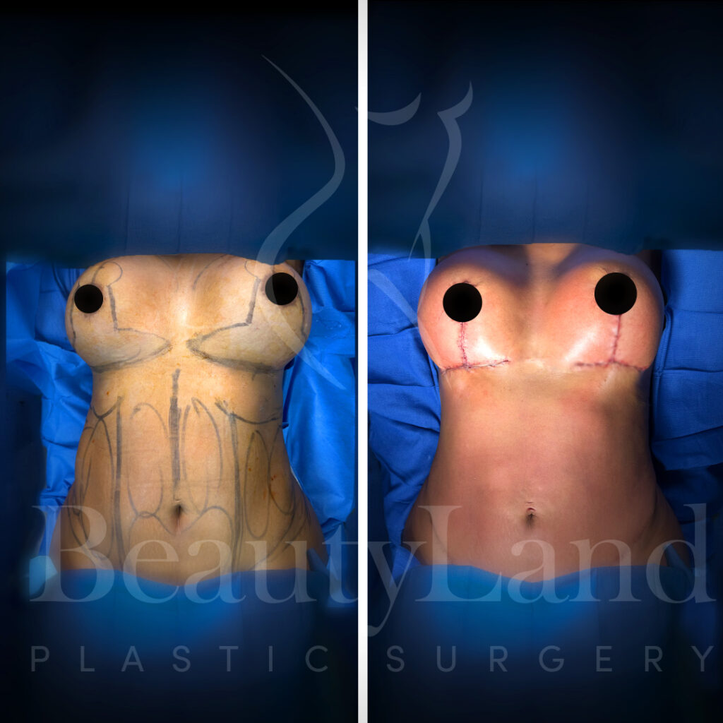 Breast Lift