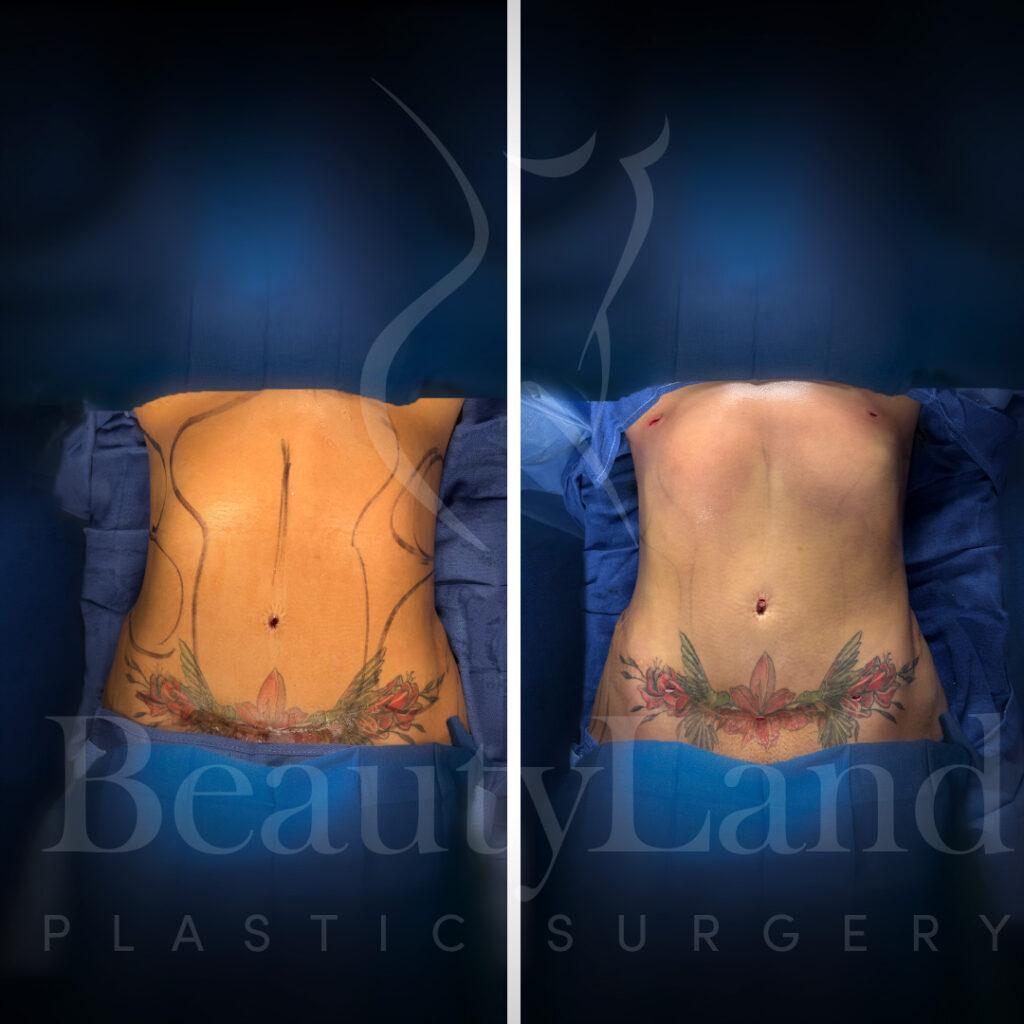 Liposuction