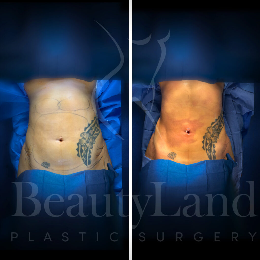 Liposuction