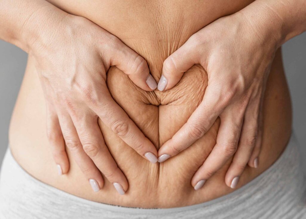 Tummy-tuck at Beautyland Plastic Surgery