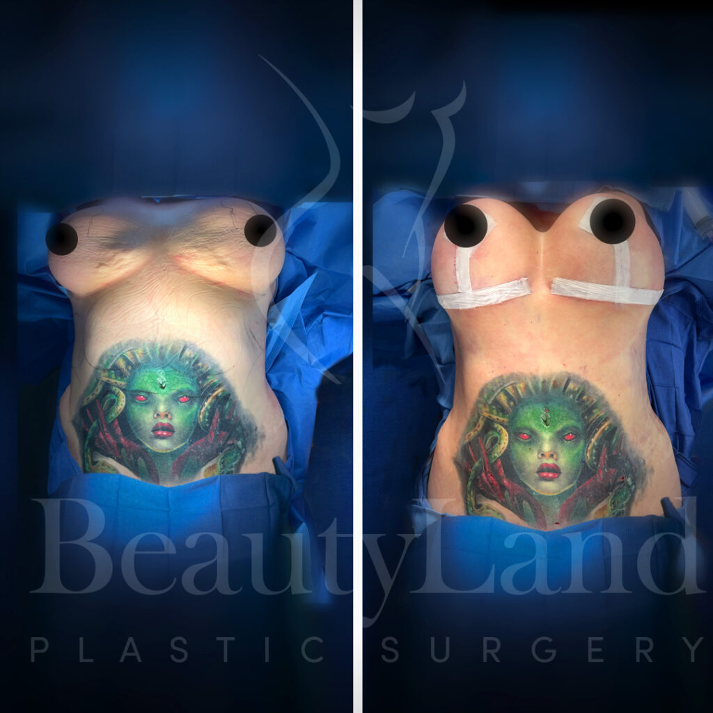 Breast Lift