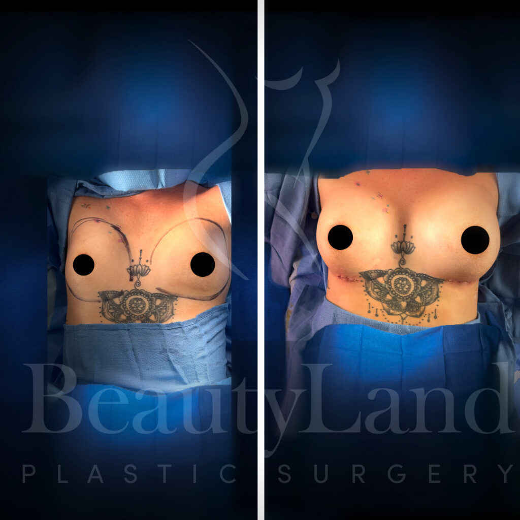Breast Augmentation