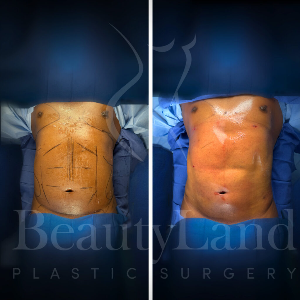 Lipo 360