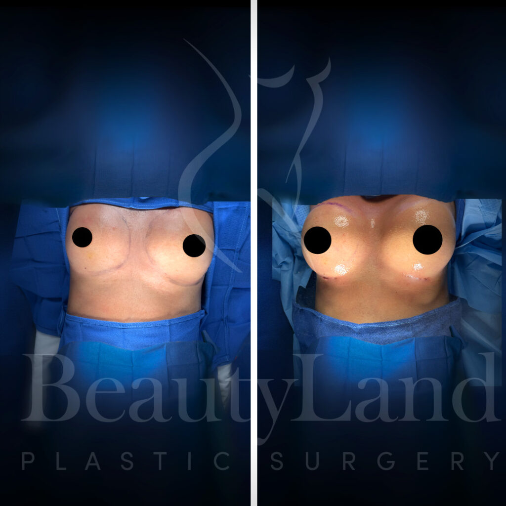 Breast Augmentation
