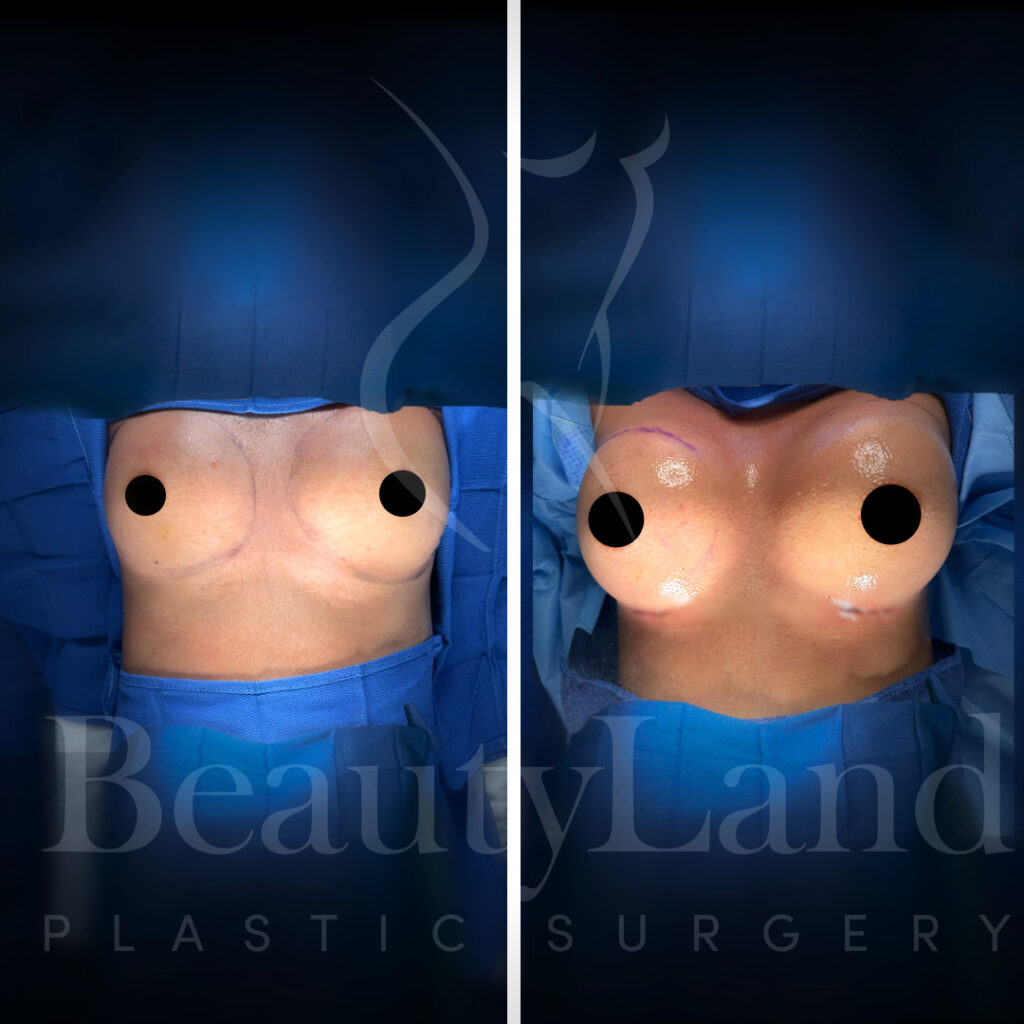 Breast Augmentation