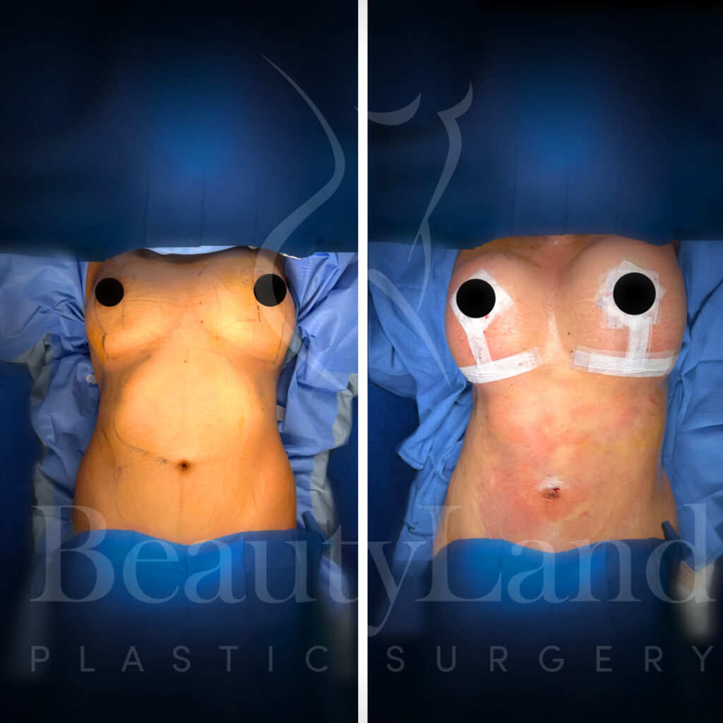 Breast Lift