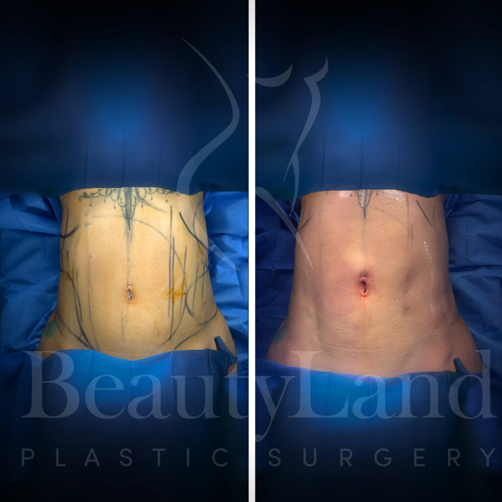 Liposuction