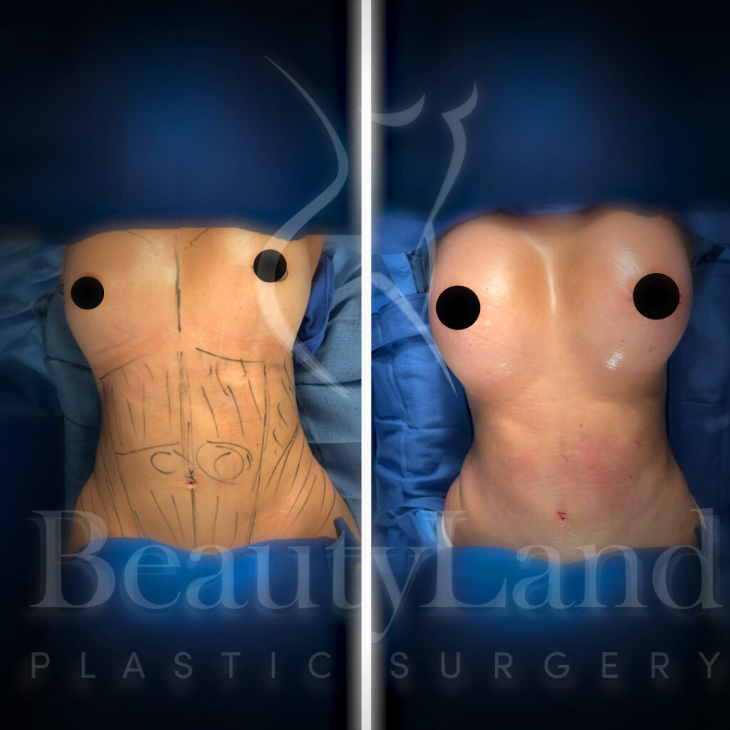 Breast Augmentation