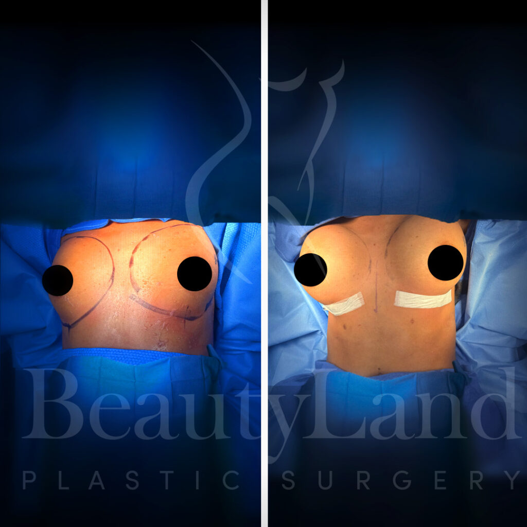 Breast Augmentation