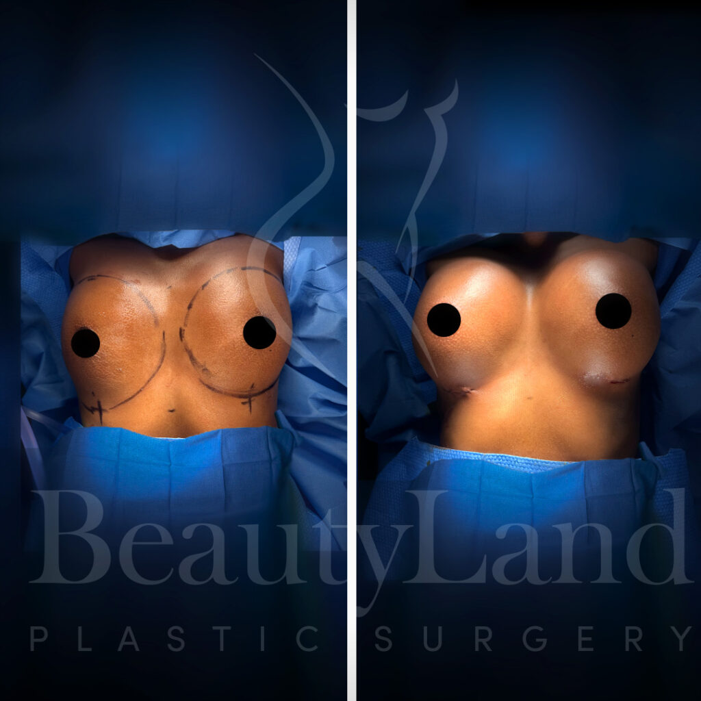 Breast Augmentation