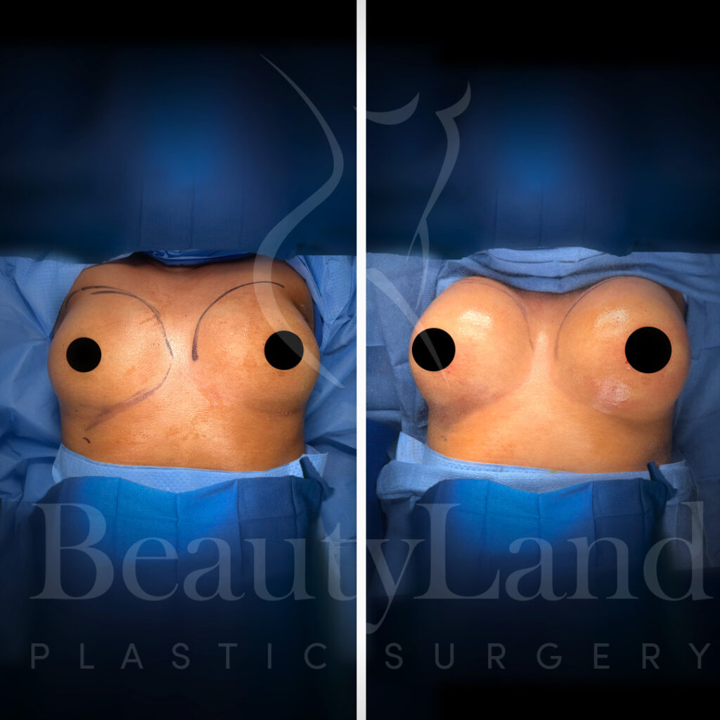 Breast Augmentation