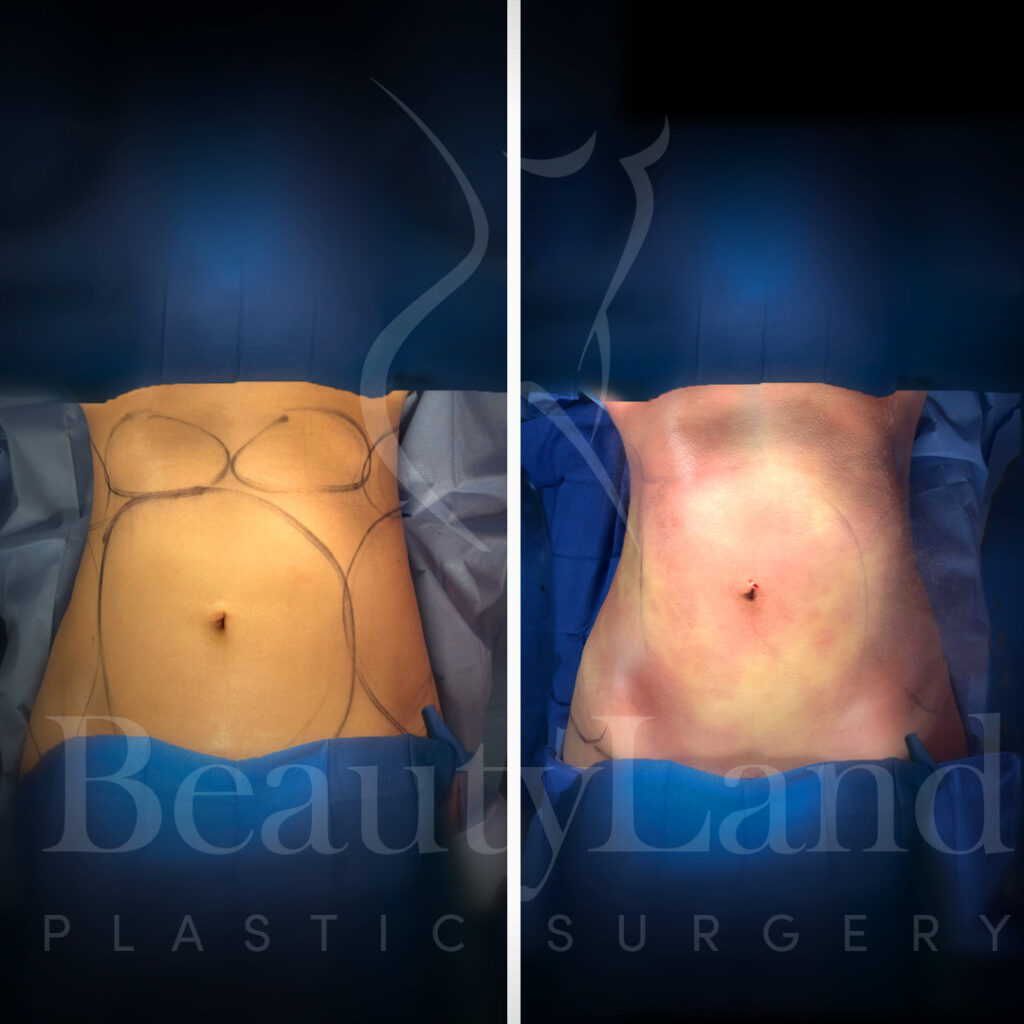 Liposuction
