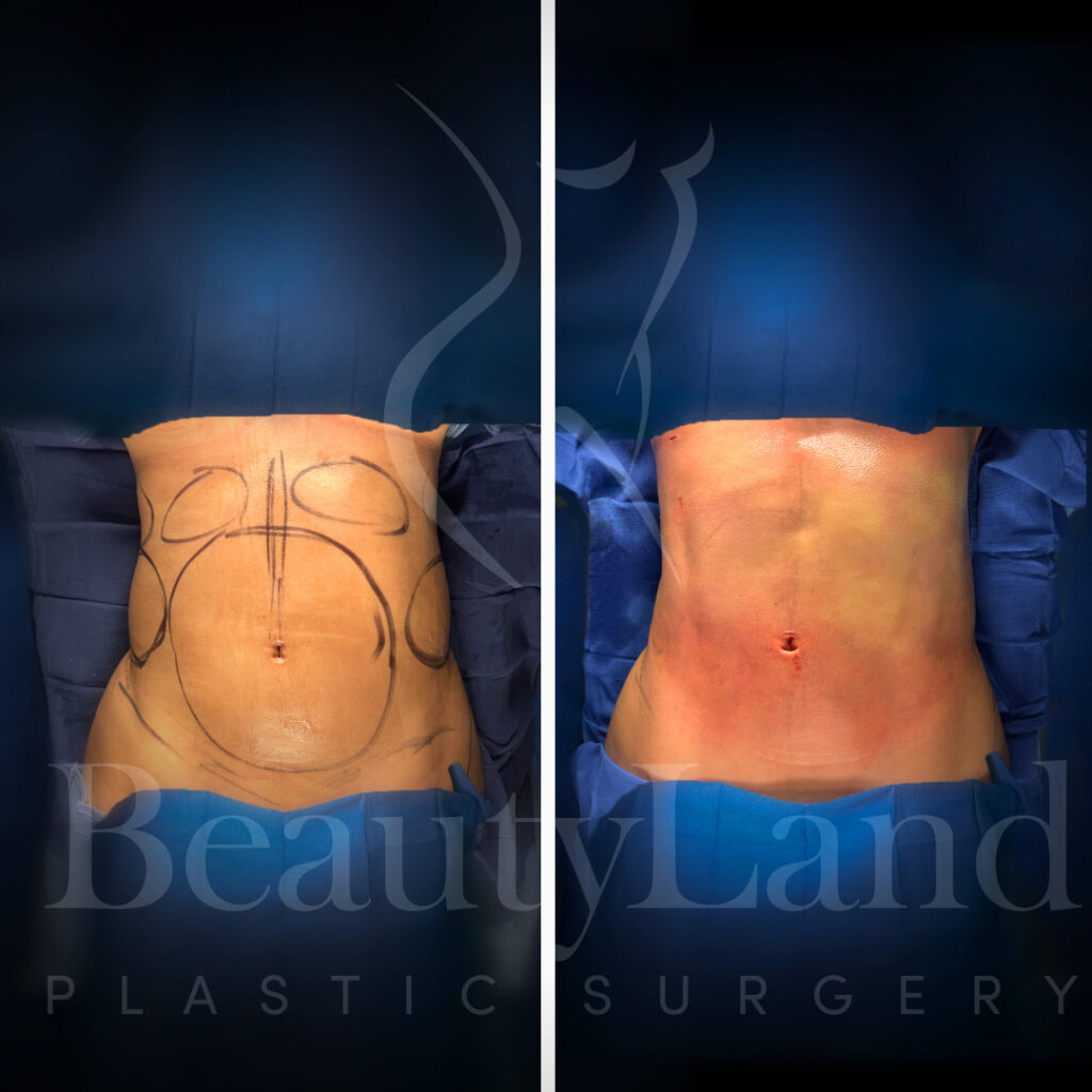 Liposuction