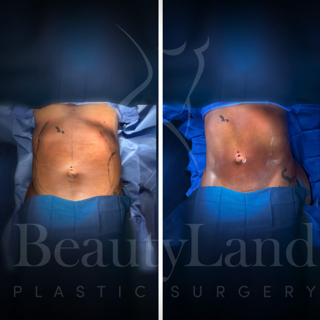 Liposuction