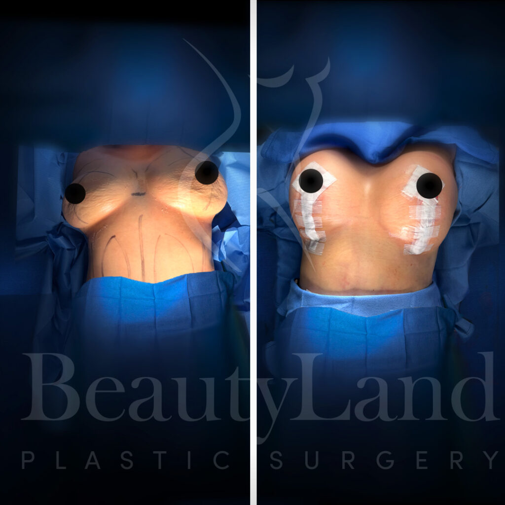 Breast Lift