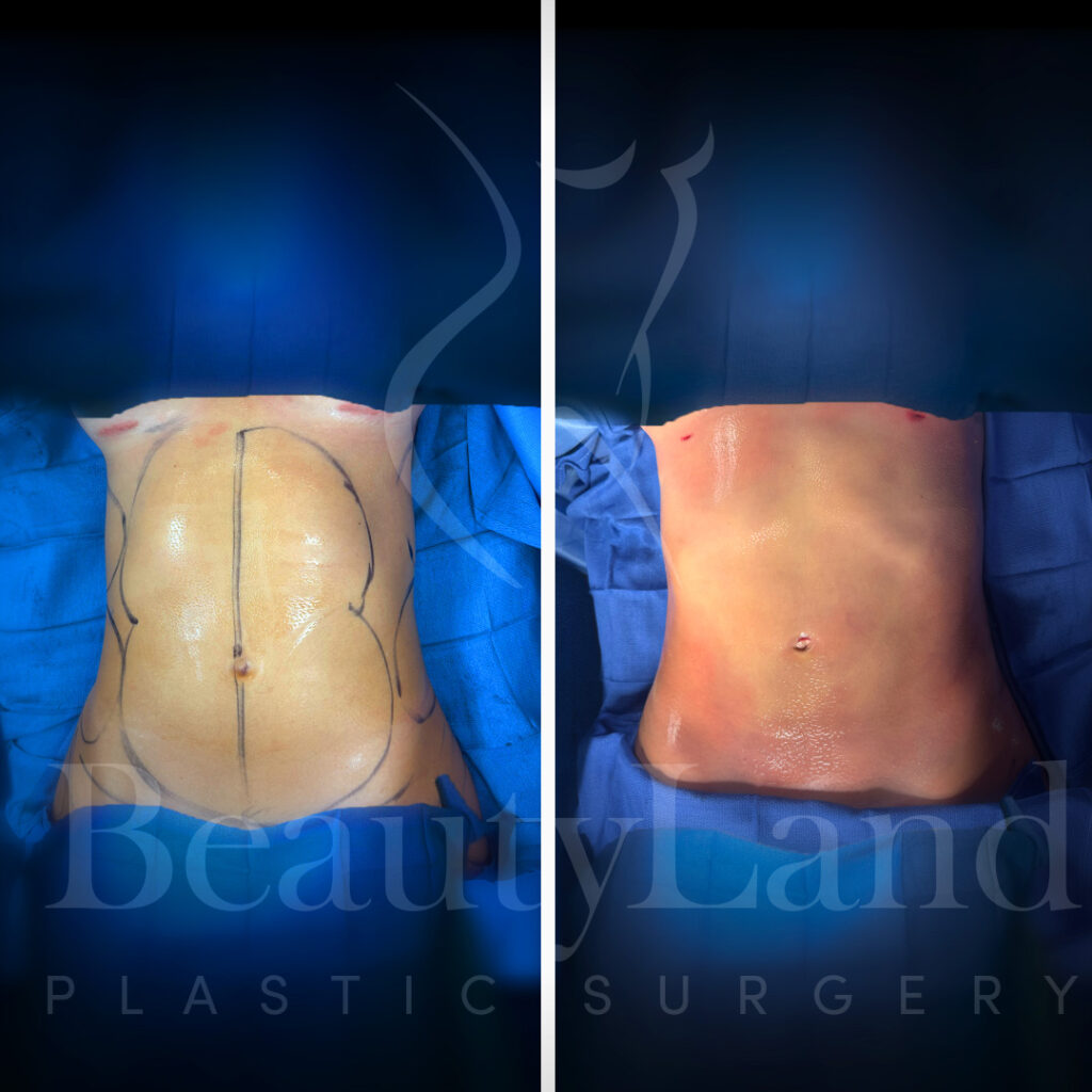 Liposuction