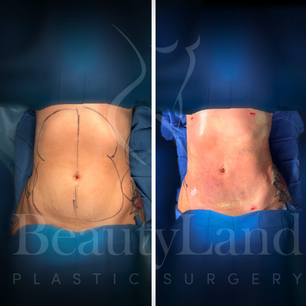 Liposuction